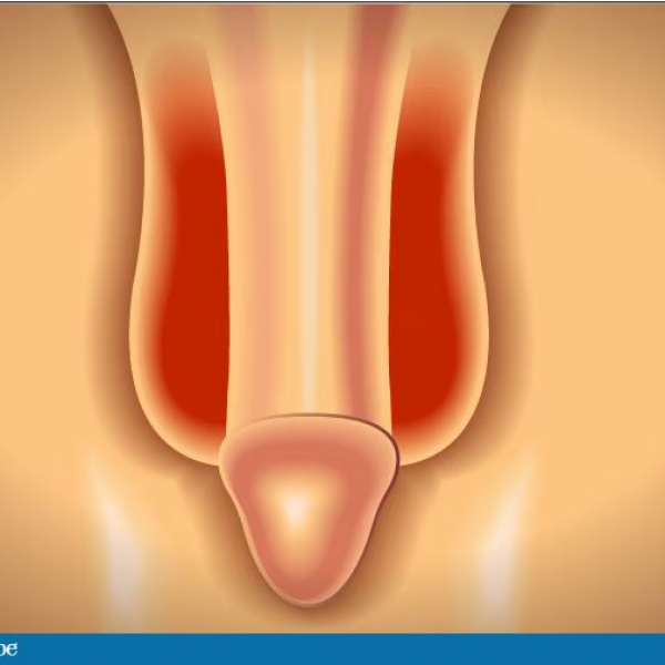 Scrotal Rash for Months