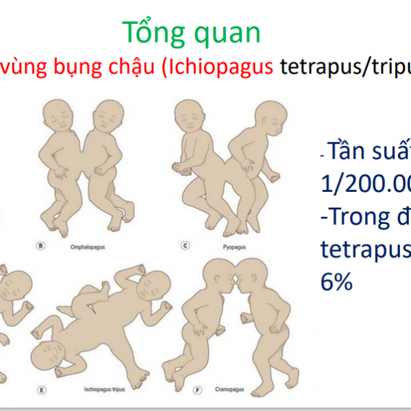 KẾT QUẢ TẠO HÌNH TIẾT NIỆU  SINH DỤC TRONG PHẪU THUẬT  CA SONG NHI DÍNH VÙNG  BỤNG CHẬU