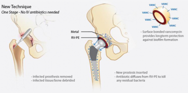 The new prosthetic coating helps prevent infection