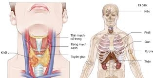 Thiết bị kênh dẫn vi lưu trong hóa trị khối u