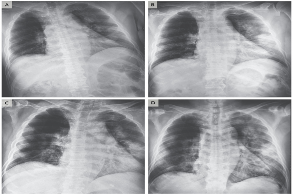 Importation and Human-to-Human Transmission of a Novel Coronavirus in Vietnam