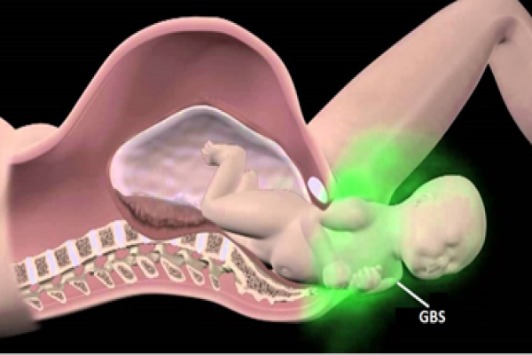 Real-time PCR detection of GBS in pregnant women PREVENT CHRONIC VIOLENCE IN CHILDREN