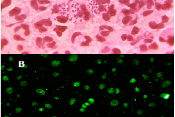 Real-time PCR detects N. gonorrhoeae and C. trachomatis