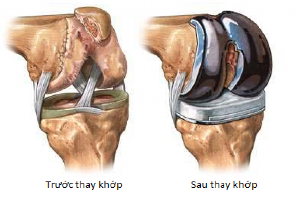 INSTRUCTIONS FOR PATIENT REPLACEMENT OF THE HEADS