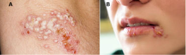 Real-time PCR detects HSV 1/2 NOT ONLY FOR LIQUID SKINS AND INTERIORS