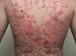 Treatment of psoriasis